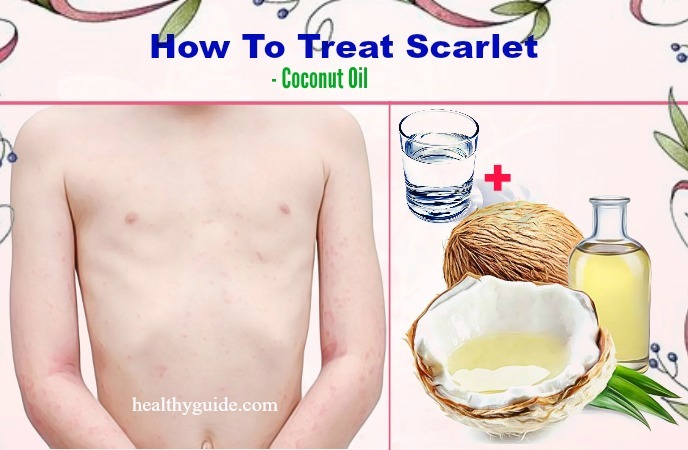 how to treat scarlet fever 