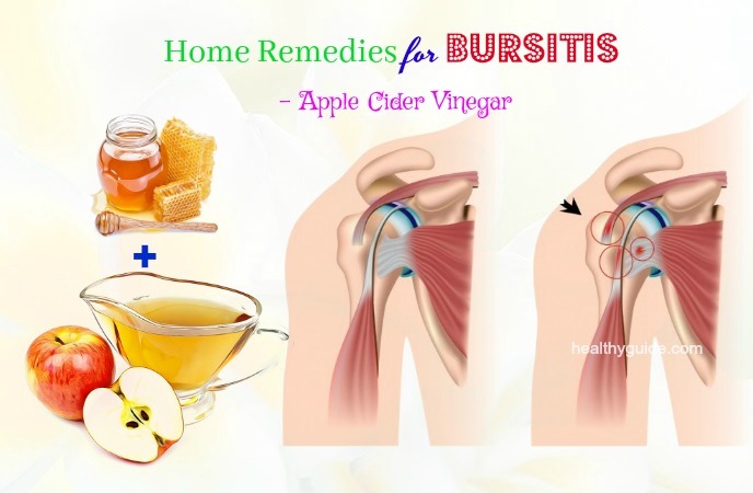home remedies for bursitis 