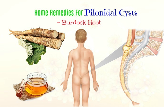 home remedies for pilonidal cysts
