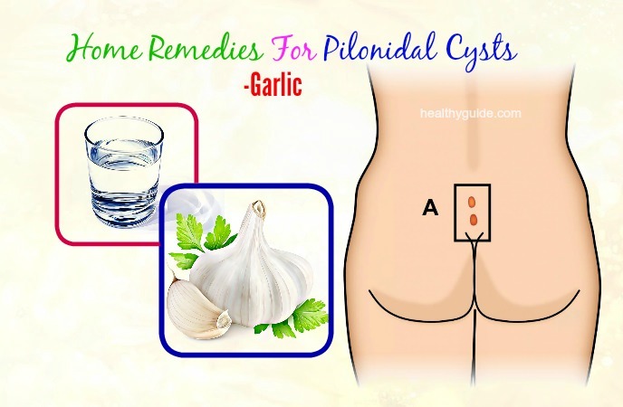 home remedies for pilonidal cysts 