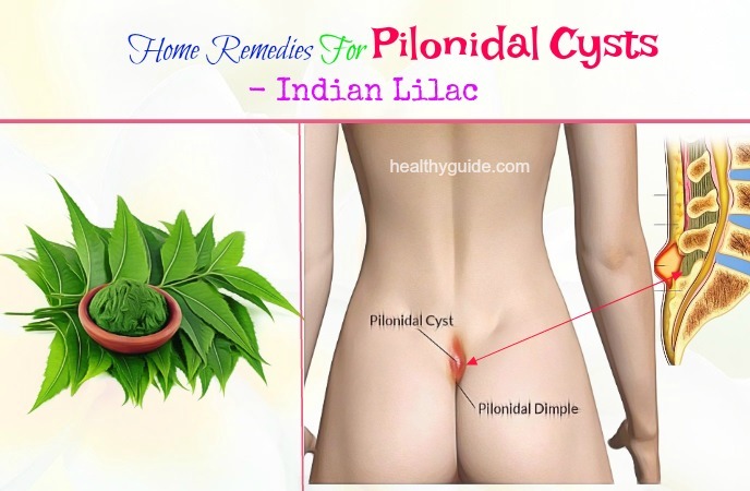 home remedies for pilonidal cysts