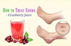 27 Tips How to Treat Edema in Face, Hands, Arms, Feet, Legs, & Knee