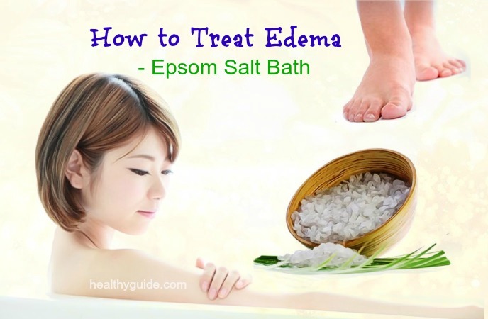 how to treat edema