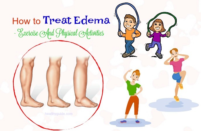 how to treat edema 