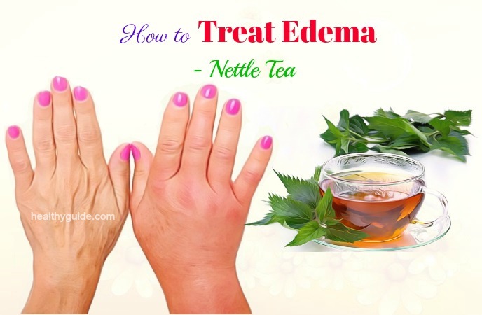 how to treat edema