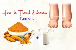27 Tips How to Treat Edema in Face, Hands, Arms, Feet, Legs, & Knee
