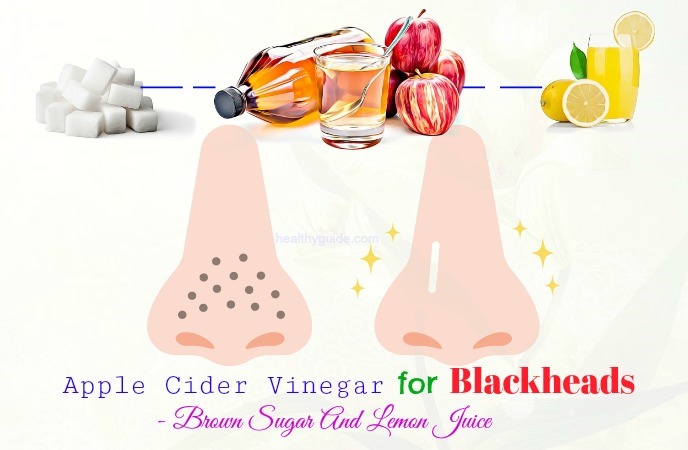 apple cider vinegar for blackheads 
